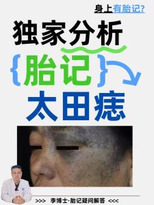 脸上有胎记好吗？体相中面部胎记详细分析