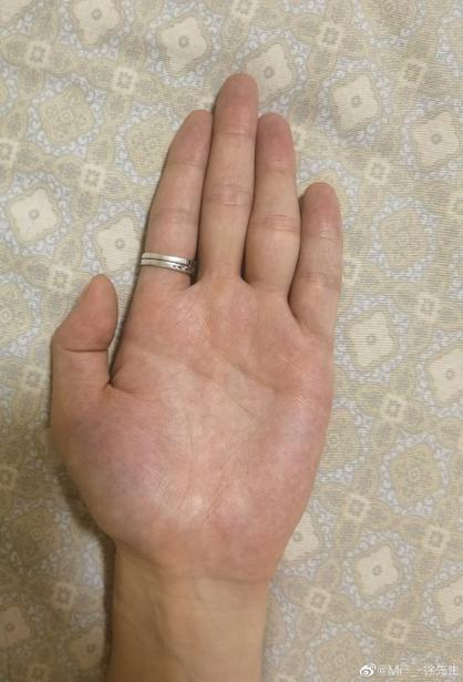 女人小拇指内弯的人命不好