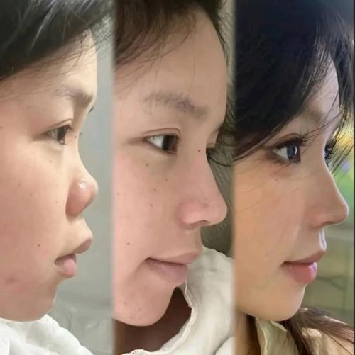 鼻梁露骨的女人好不好 怎么看