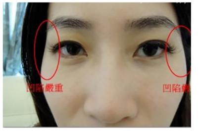 奸门低陷的女人容易晚婚吗