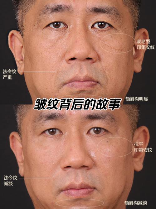 颧骨有纵纹的男人官运不通是为什么