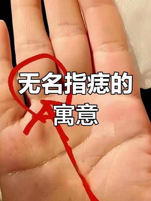 女人右手无名指长新痣 事业运势较喜人
