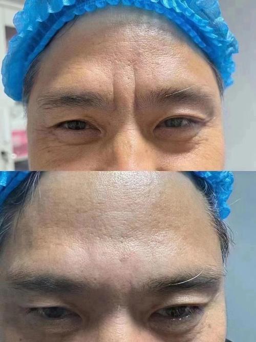 男人有抬头纹会有好运吗