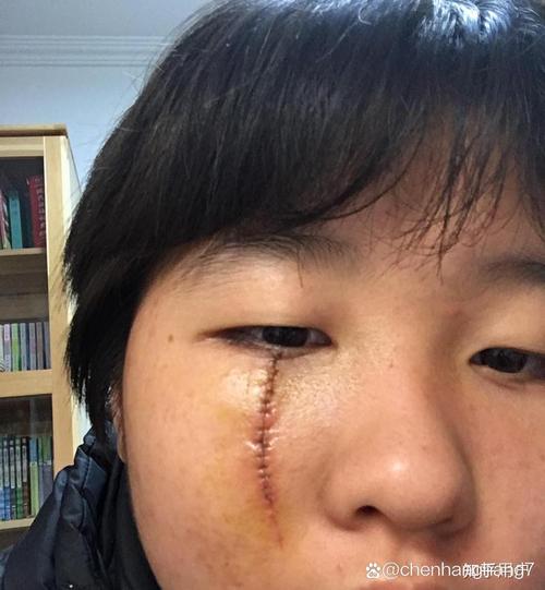 脸颊有疤痕面相好不好