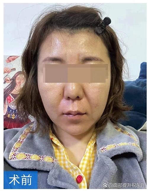 下巴短小对晚年影响大吗