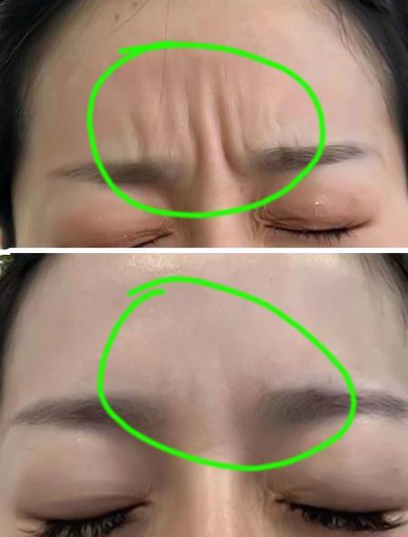 为什么说有悬针纹运气不好有劫难