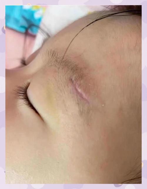 后天眉毛有疤的命运 眉毛上后天形成的疤好吗