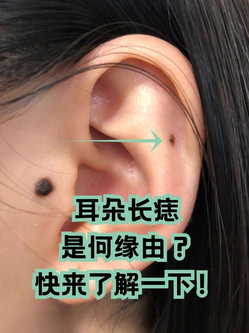 长在耳朵内部的是不是富贵痣？影响如何