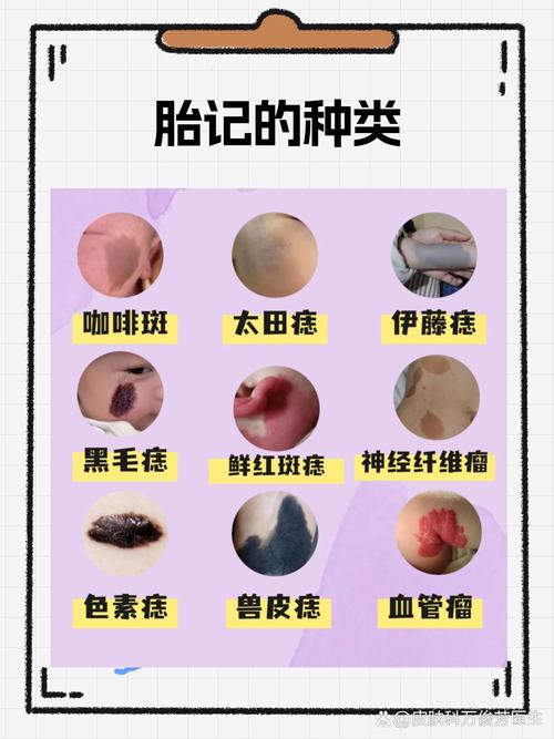 宝宝额头上有胎记说明什么？