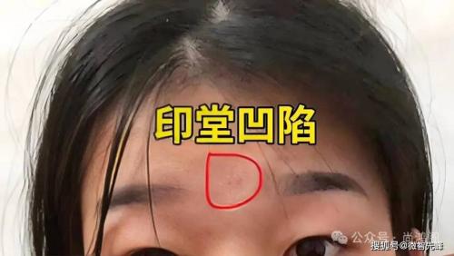 女人印堂有疤痕命太好