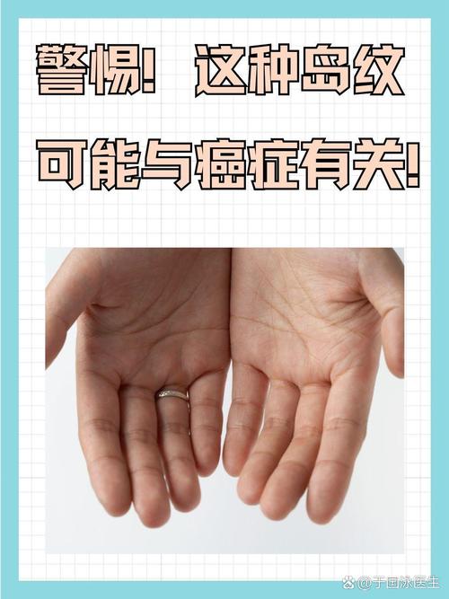 手上有岛纹预示着肿瘤吗