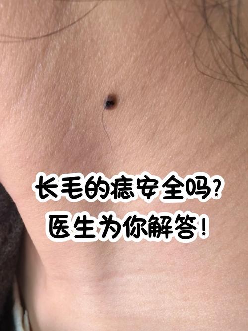 为什么痣上会长毛？