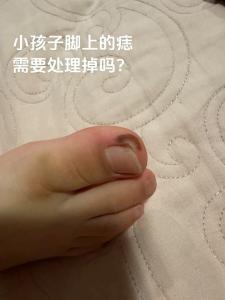 大脚趾长痣