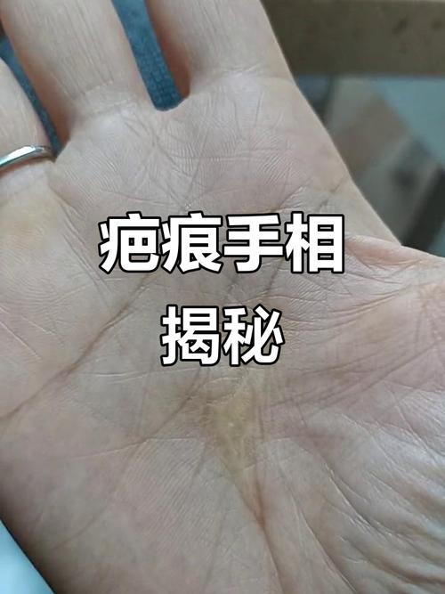 从手相疤痕看你要注意什么