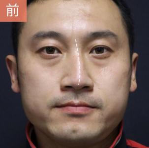 鼻梁歪的男人命运好吗？命途多舛，一事无成！