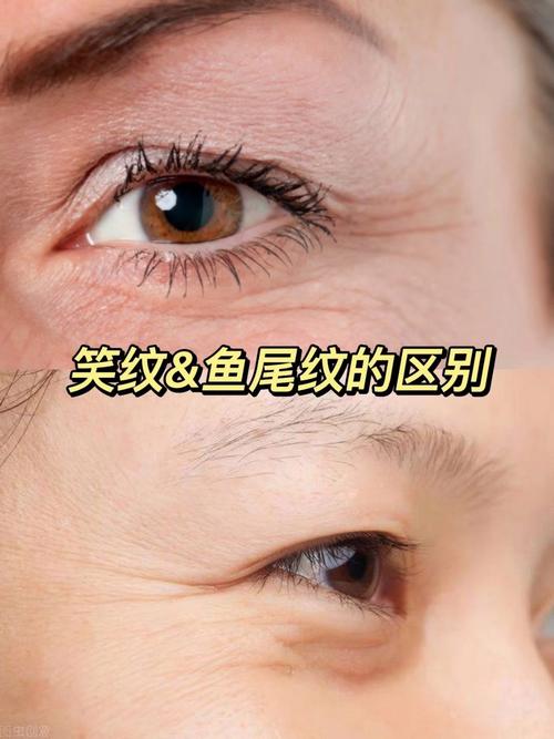 鱼尾纹和阴骘纹的区别
