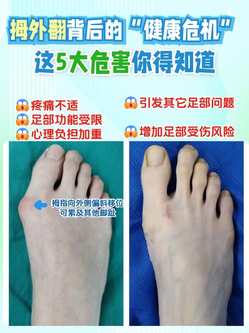 女人脚拇指外翻命不好 拇外翻的脚克夫吗