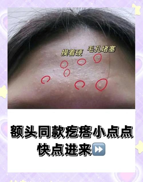 额头小怎么办？