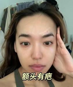 额头有疤痕的面相,面相：脸上哪些地方不宜有疤痕