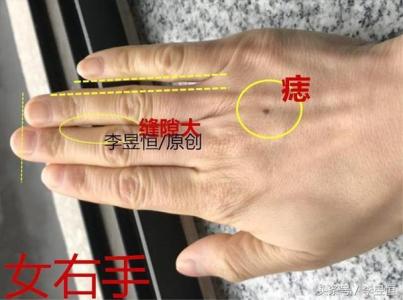 痣相 男人右手背长痣如何
