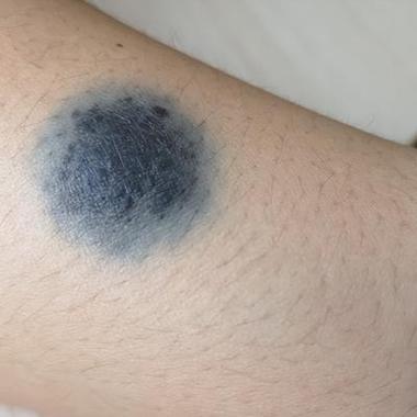 青色胎记和黑色胎记的区别