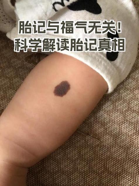 从胎记看运势怎么样