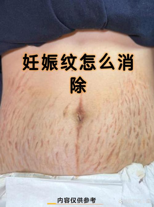 妊娠线会自己消失吗