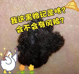 黑色胎记有什么意义