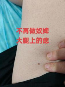 腿上长痣好不好