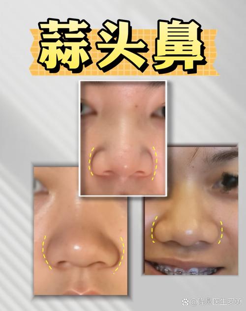 蒜头鼻长什么样,什么是蒜头鼻