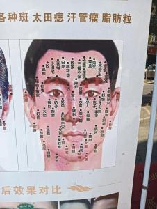 男人脸上哪些痣不能去掉 鼻子痣不能点
