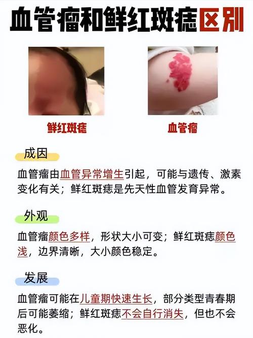 什么是红胎记