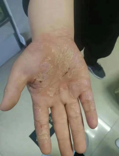 手掌干枯肉薄的人多受苦吗