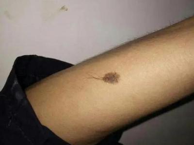 男人身上哪里长毛大富大贵 痣上毛多
