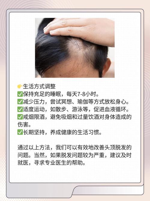 男人头发秃顶说明什么