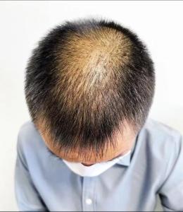 头发稀少的人命运好吗