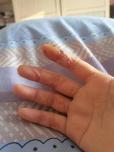 手指受伤留疤影响运势吗