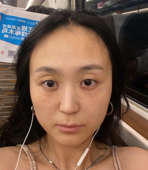 眼窝凹陷是不吉之相吗