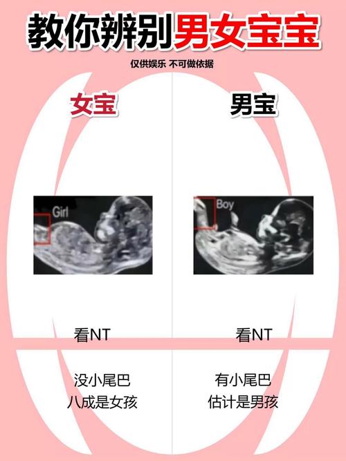 妊娠线可预示生男吗
