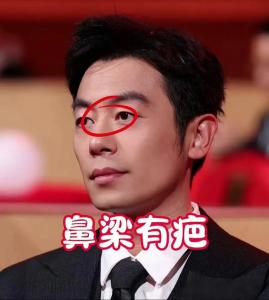 山根有疤的男人好不好 命运如何
