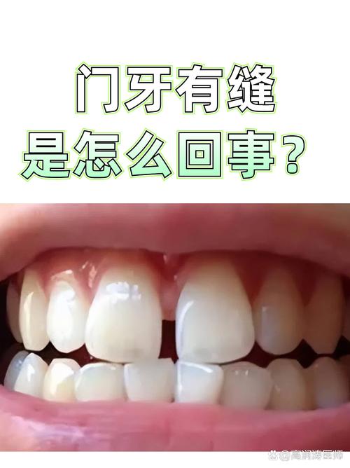 门牙有缝隙是好还是坏？