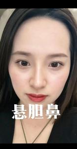 什么是悬胆鼻